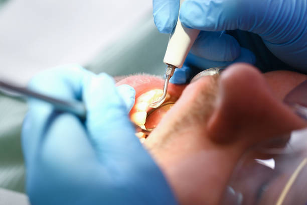 Best Emergency Wisdom Tooth Extraction in Perrysburg, OH